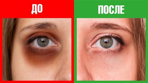 Как избавиться от темных кругов под глазами навсегда