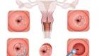 Masť na eróziu krčka maternice: indikácie a kontraindikácie