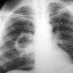 Absces pľúc - príznaky, diagnostika a liečba Obdobia abscesu