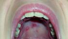 Stomatitída: liečba dospelých doma Symptómy stomatitídy v ústach