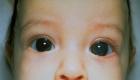 Glaukóm u detí: príčiny výskytu Príznaky glaukómu u dieťaťa 10 mesiacov