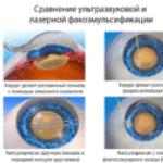Výhody a technika operácie katarakty