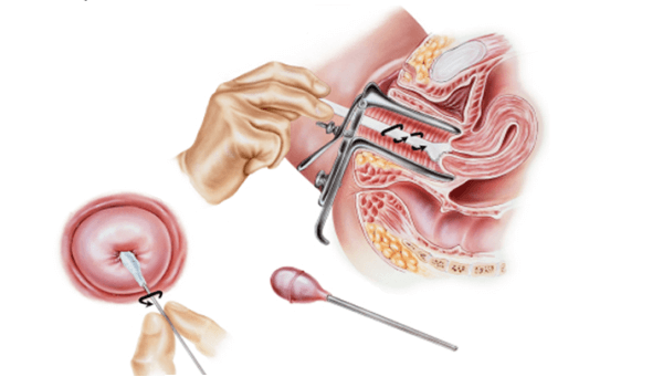 Interpretazione dell'oncocitologia cervicale