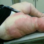 एडिमा वैरिकाज़ नसों के साथ पैरों की त्वचा के ट्रॉफिक विकारों का उपचार ट्रॉफिक परिवर्तन
