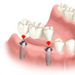 معرفة أي الأسنان هي الأفضل لإدخال: جميع أنواع الأطراف الصناعية