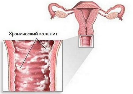 Bau vagina saat menstruasi