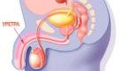 Anomálie močovej trubice: zúženie a obliterácia Vonkajšie otvorenie močovej trubice u žien