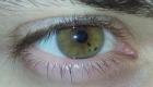 Aké škvrny na očných viečkach vám povedia: typy, choroby a liečba Čo znamenajú škvrny v očiach ako značky