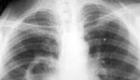 Absces pľúc - príznaky, diagnostika a liečba Obdobia abscesu