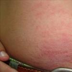 Allergi mot spiralsymtomen Sätt spiralen kan det finnas en allergi
