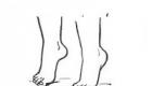 قواعد الجمباز العلاجي بأقدام مسطحة