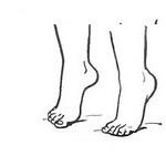Pravidlá terapeutickej gymnastiky s plochými nohami