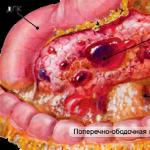 Az akut pancreatitis szövődményeinek sebészeti kezelése