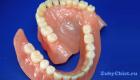 Aké sú spôsoby vloženia zubov