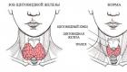 Gondok nodular pada kelenjar tiroid: apa itu dan bagaimana cara mengobatinya?