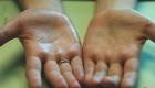 Ako sa zbaviť spotených dlaní: 11 spôsobov