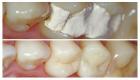 مما تتكون حشوة الأسنان؟